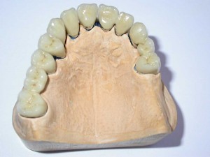 laboratoire prothésiste dentaire nimes gard, céramiques