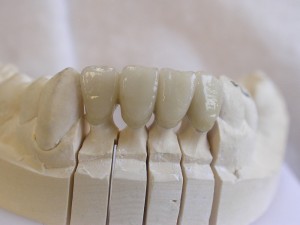 laboratoire prothésiste dentaire nimes gard, céramiques
